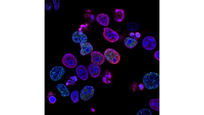 ACSR to Employ Digital Pathology for HIV-Related Cancers