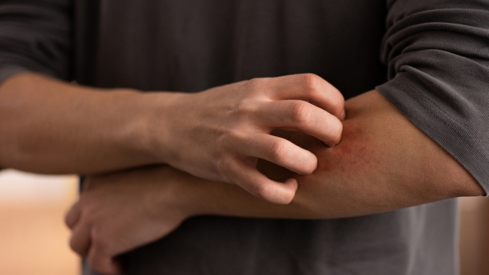 Belfast Man Overcomes Severe Eczema, Described as Worst Case in Northern Ireland