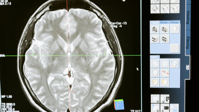 Innovative MRI Technology Reveals Brain Changes Post COVID-19