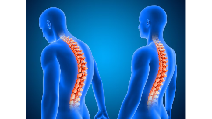 Spinal surgery restores life to Colorado woman previously immobilized by severe scoliosis